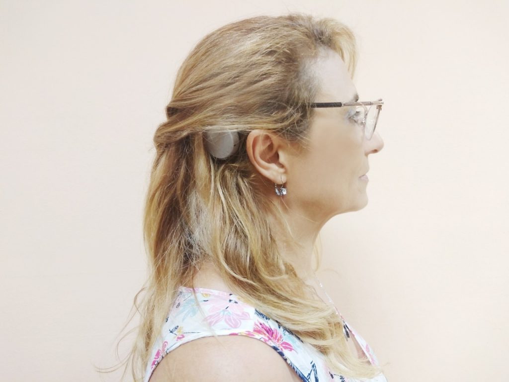 Mariángeles y su Implante Coclear