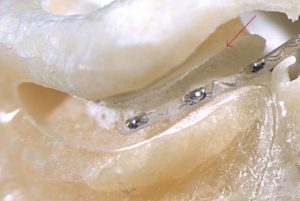 waarom-structuurbehoud-van-de-cochlea-zo-belangrijk-isflexibiliteit3 waarom-structuurbehoud-van-de-cochlea-zo-belangrijk-isflexibiliteit